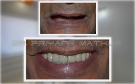 All on Four Full Mouth Dental Implants