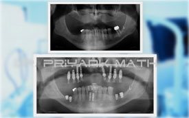 Full mouth Rehab with dental implants