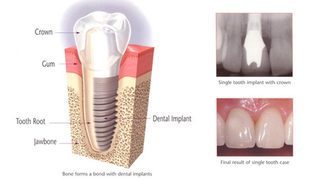 Dental Implant Procedure