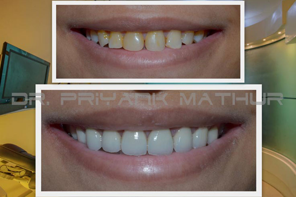 Smile Makeover with 3M LAVA Crowns