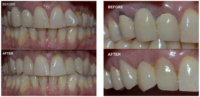 Dental Bridge Treatment in India 