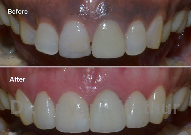 Gum Depigmentation Pune