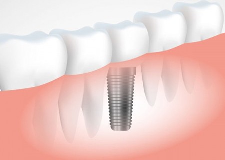 teeth implants cost in india