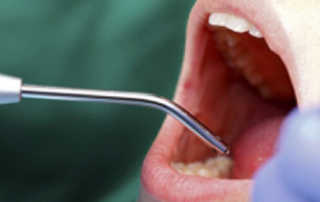 Dental Implants in Pune India