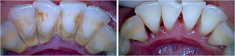 Scaling Polishing Teeth Cleaning