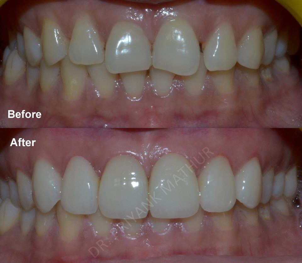 Simple Porcelain Veneers to improve your smile