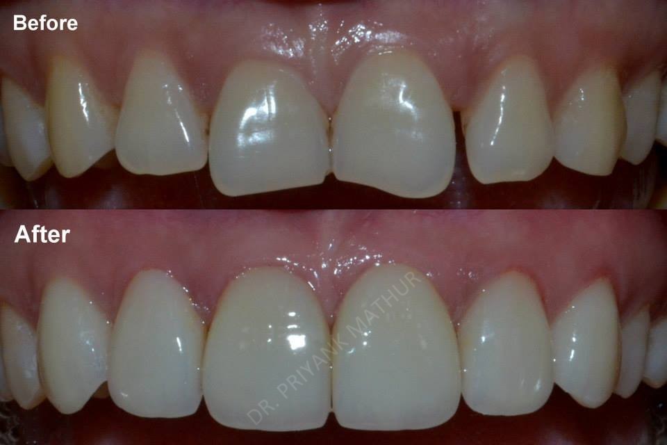 Upper teeth Porcelain Veneers to improve your smile