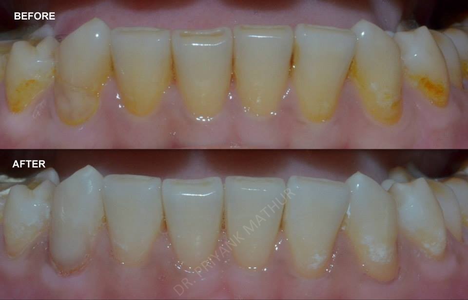 Lower teeth whitening