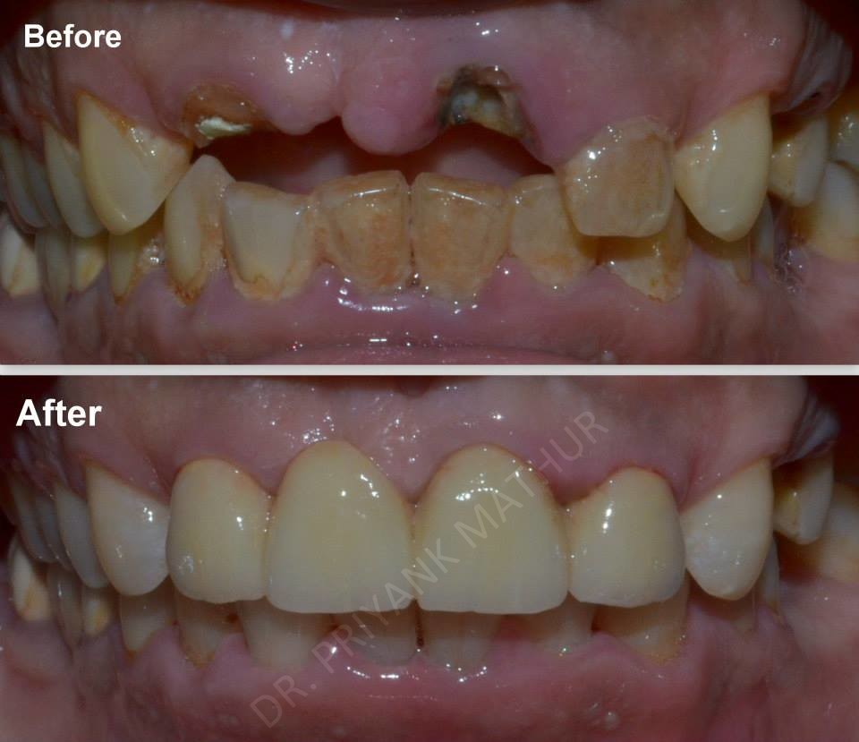 Teeth Replacement using Czar Zirconia Bridge