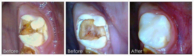 Composite dental filling