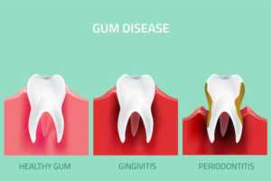 Gum Disease Treatment