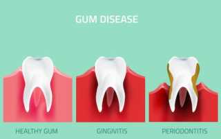 Gum Disease Treatment