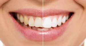 Smile Makeover in Pune