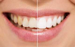 Smile Makeover in Pune