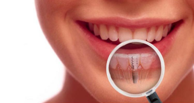 Dental Implants in India