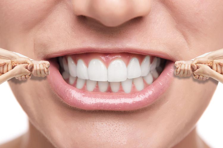 Invisalign Braces in India