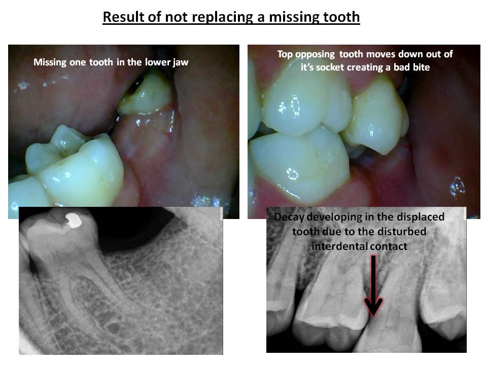Restorative Dentistry in Pune