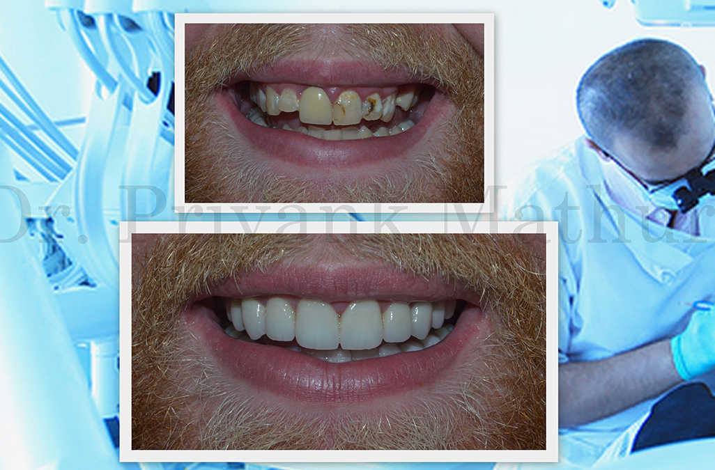 Smile makeover, smile designing in Pune, India