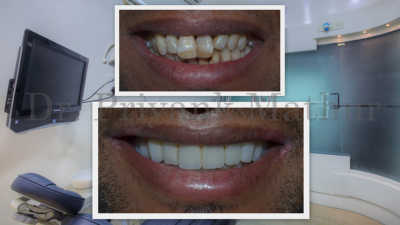 Full Mouth Rehabilitation With Dental Implants In India | Smilekraft