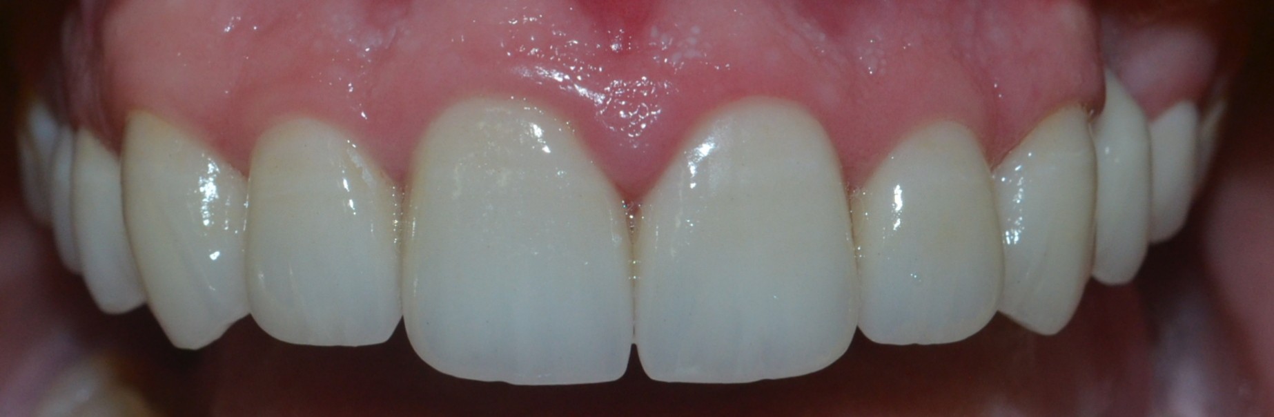 Teeth with Dental Crowns in Pune, India