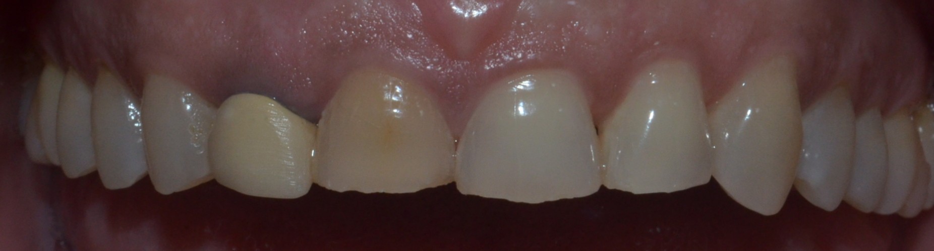 upper teeth before