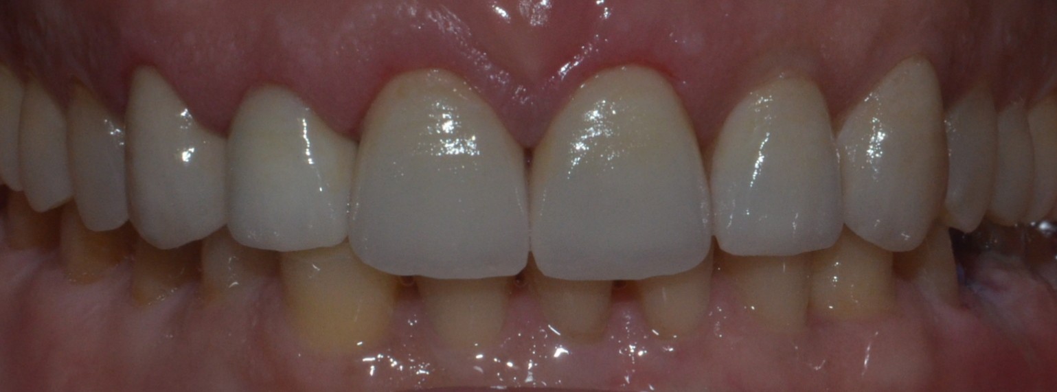 Smile Makeover with Emax crowns & veneer