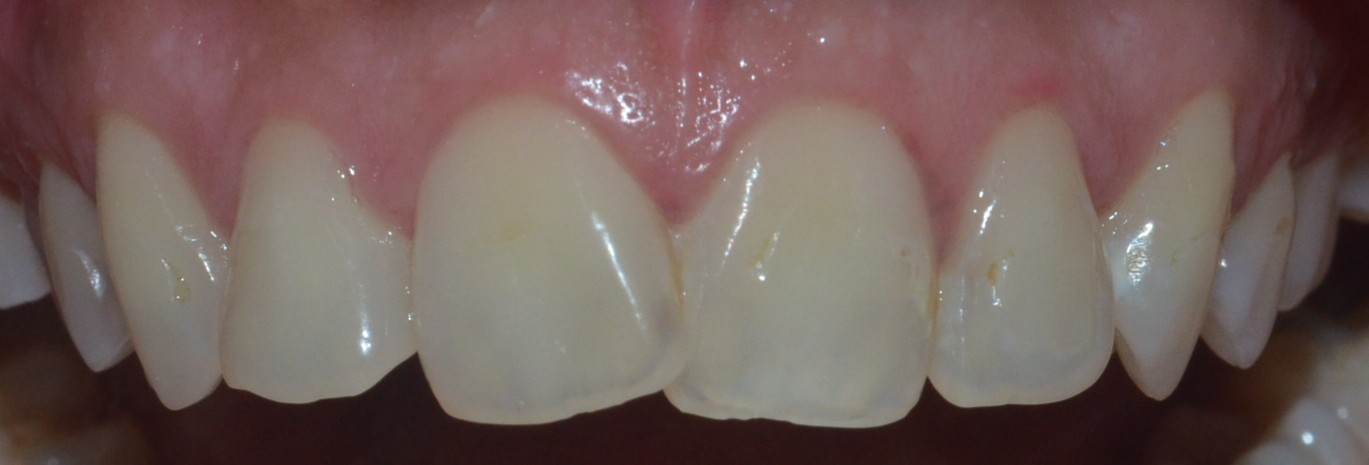 Misshaped & misaligned teeth