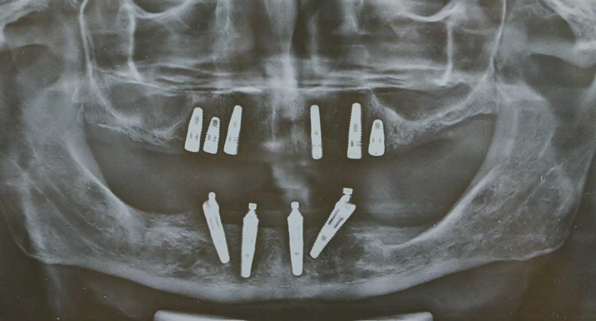 All on Four/Six dental implants in India | Full mouth dental implants