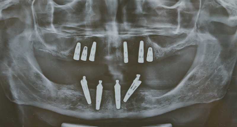 All on Four/Six dental implants in India | Full mouth dental implants ...