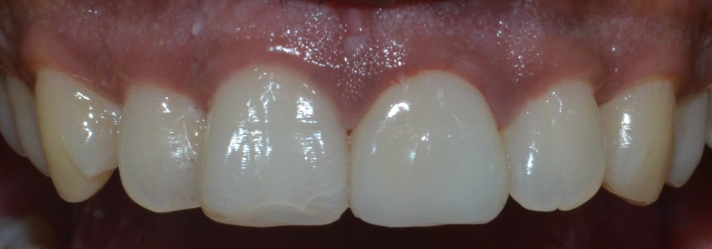 Dental crown fro a fractured tooth