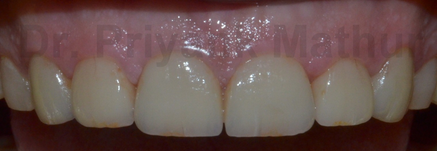 Dental crowns to repair wear & tear