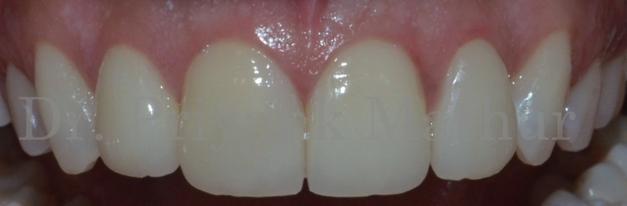Dental crowns to treat misshaped & misaligned teeth