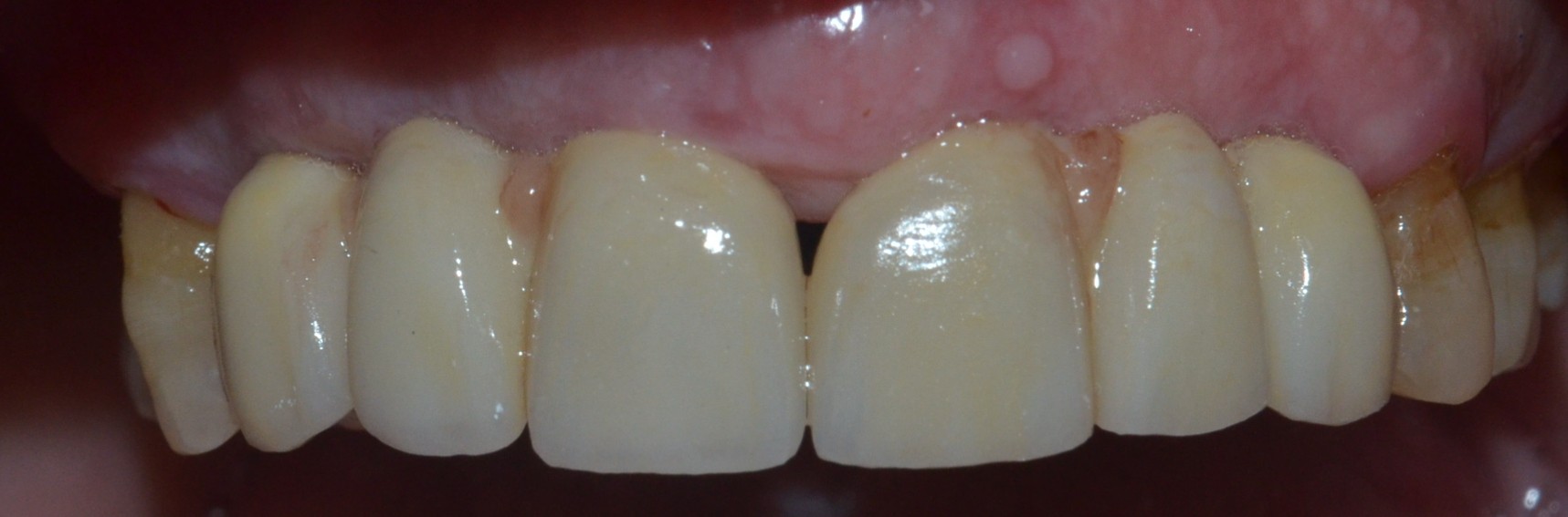 Crowns on dental implants