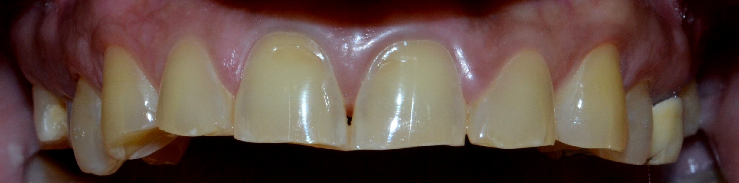 Before (upper teeth)
