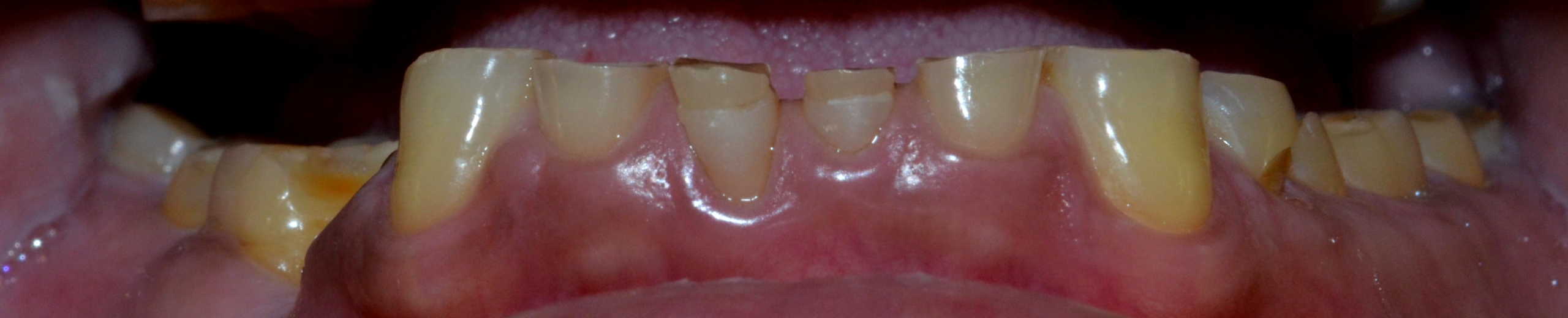 Before (lower teeth)