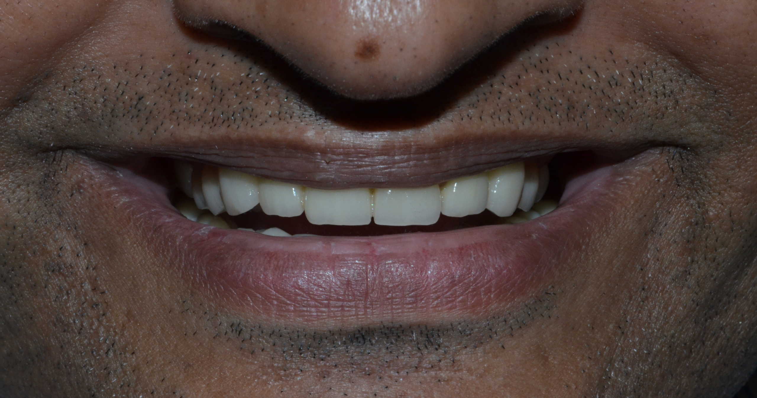 full mouth rehabilitation in Pune, India
