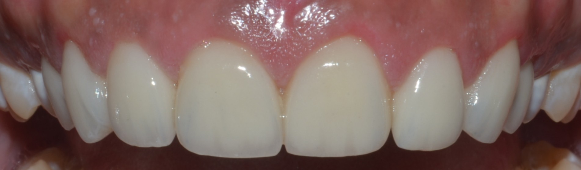 dental crowns for discoloured teeth