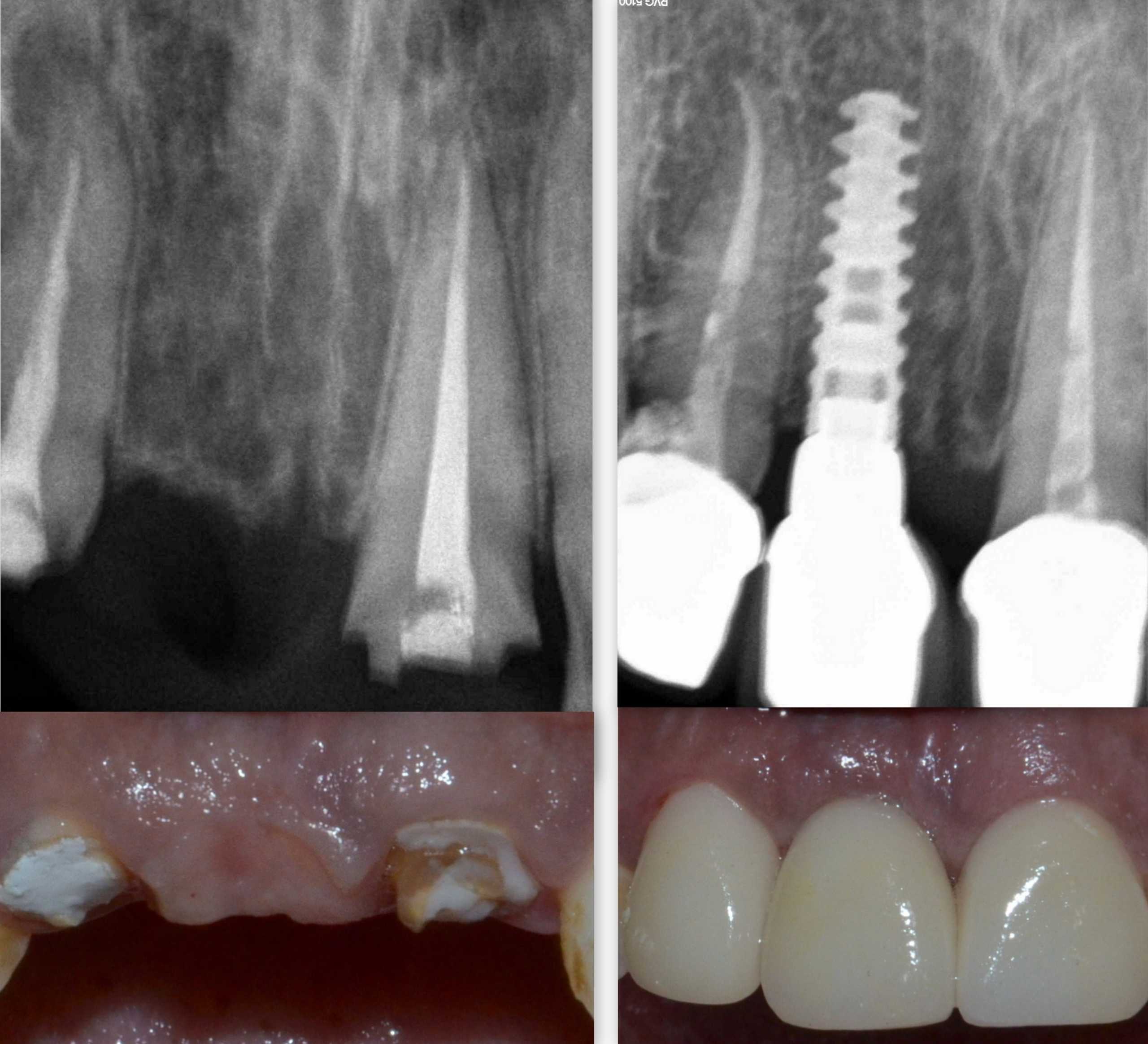 Dental implant in Pune