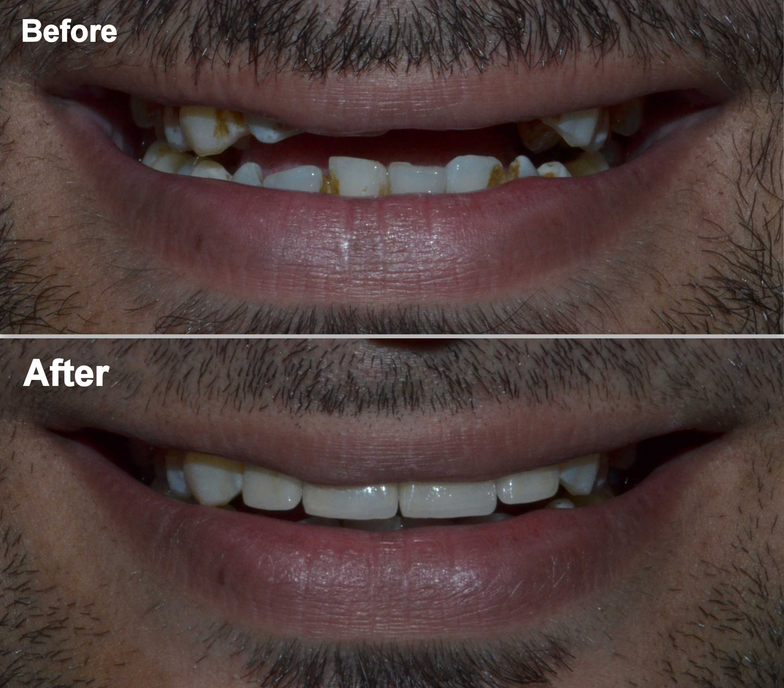 dental crowns for smile improvement