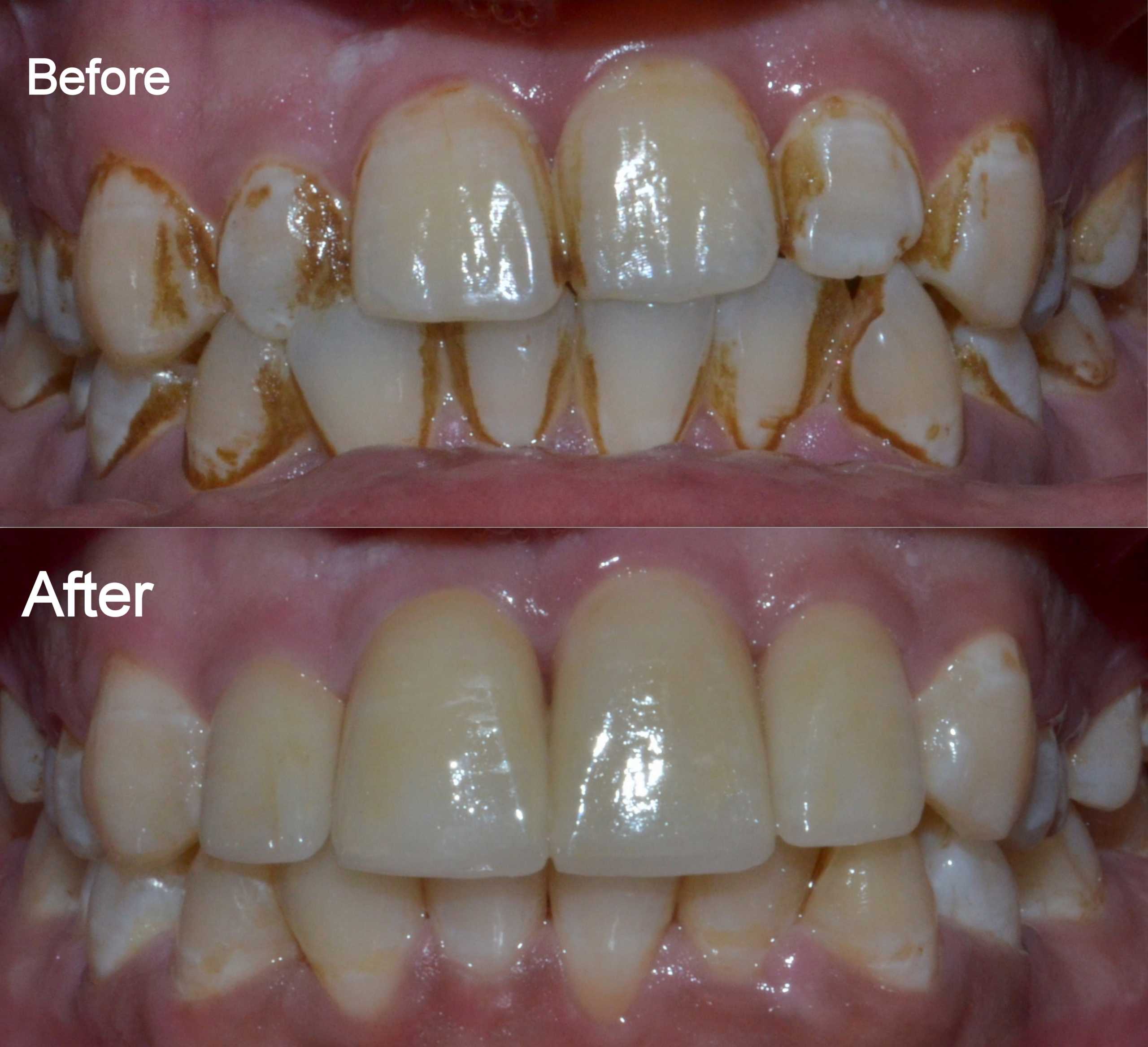 dental crowns to correct bite and increase size of teeth