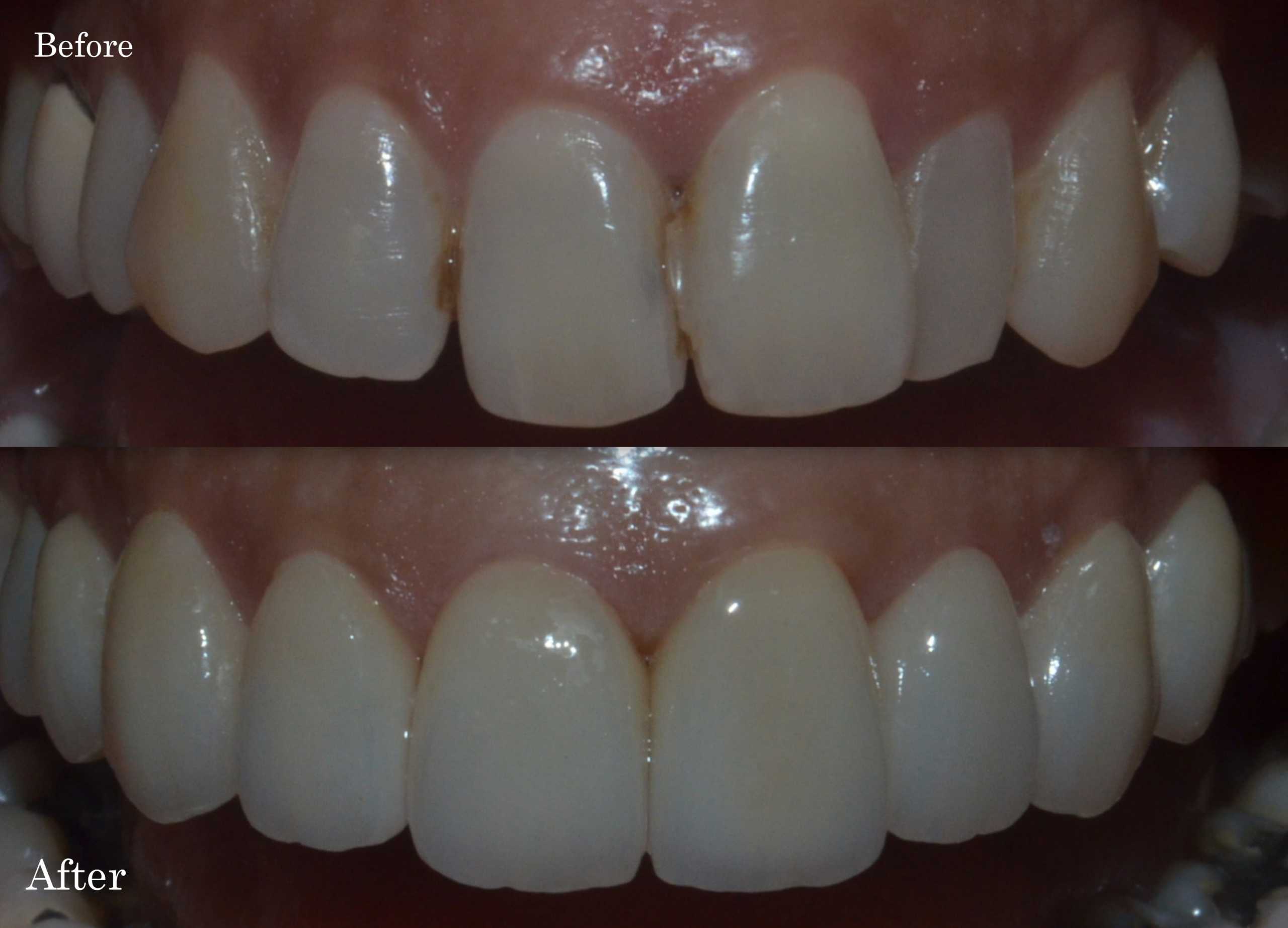Porcelain veneers to align and make teeth cavity free